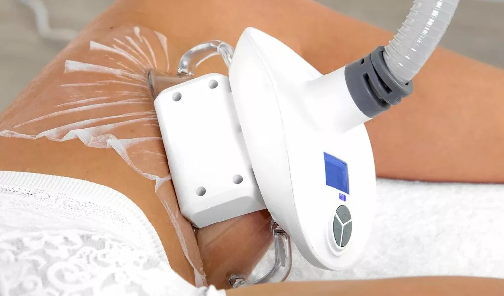 combien de séances de cryolipolyse pour la cuisse ?